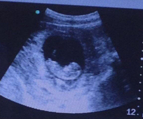 Spooky ultrasound
