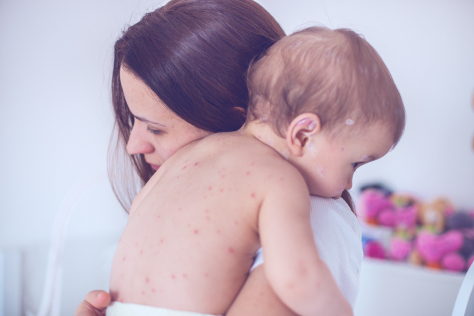 Chicken pox 474