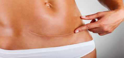 Everything You Need To Know About C Section Recovery The Everymom