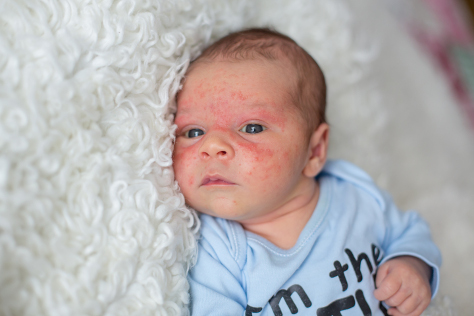 when should i worry about baby acne