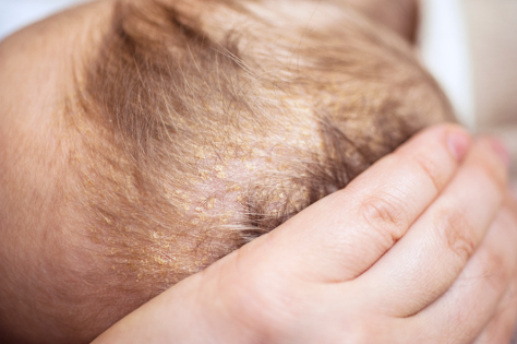 Cradle cap 474